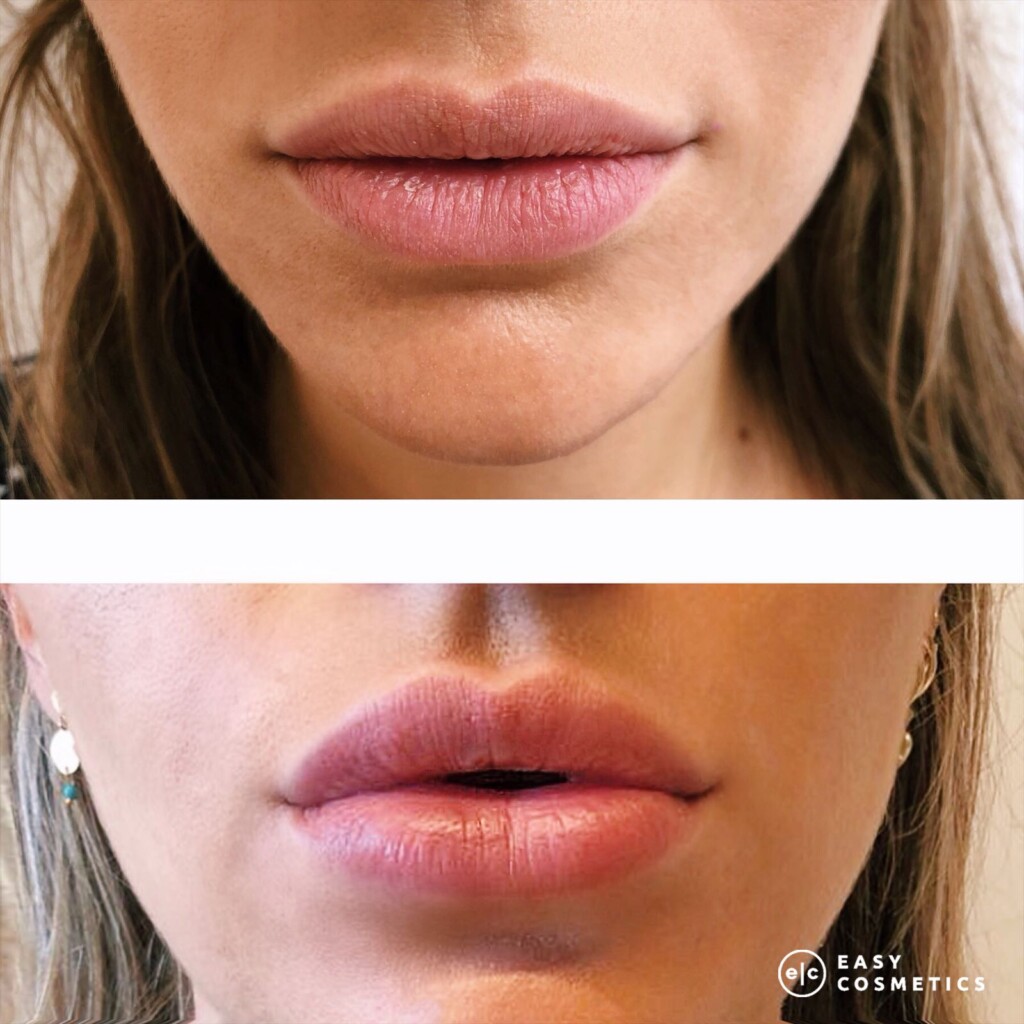 Hoe Lang Blijven Fillers Zitten? - Easy Cosmetics