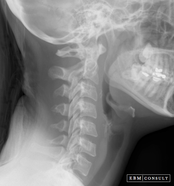 Lateral Cervical Spine Radiograph (XRay) How to Read