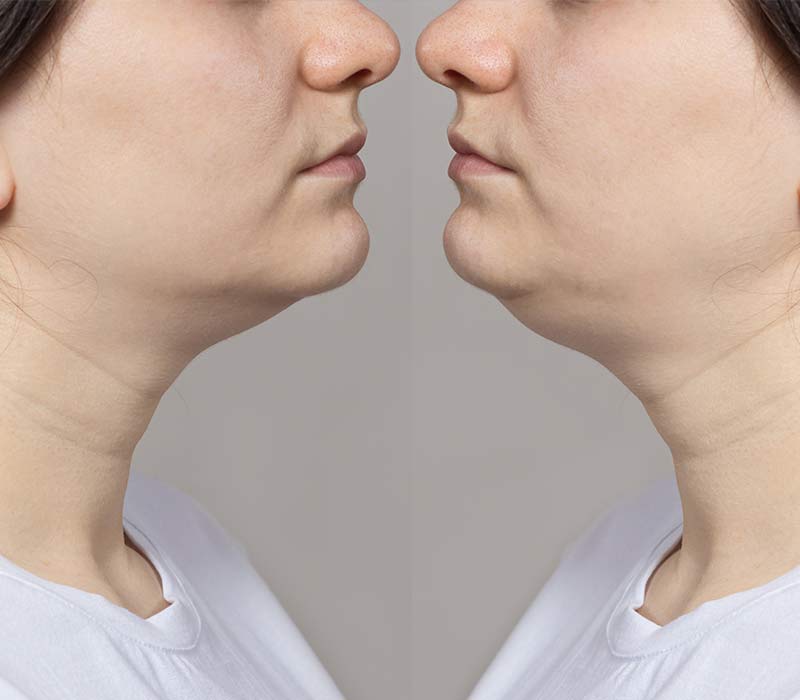 Double Chin Reduction CCOCO BEAUTY