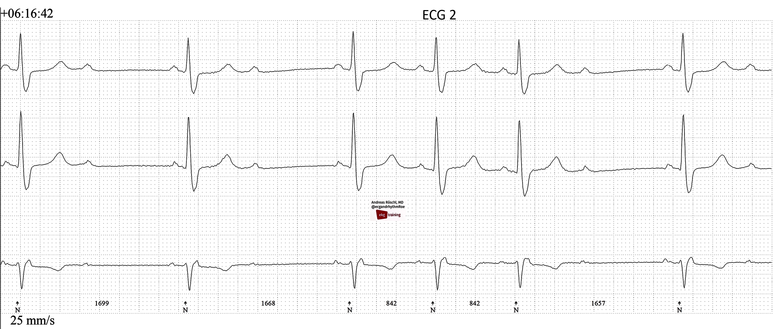 Sinus Tachycardia Rhythm Strip