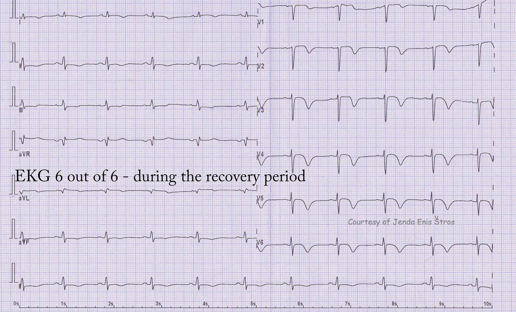 Teaching Series 1113 ECG 6 of 6 Acute Anterior Wall M.I. ECG Guru