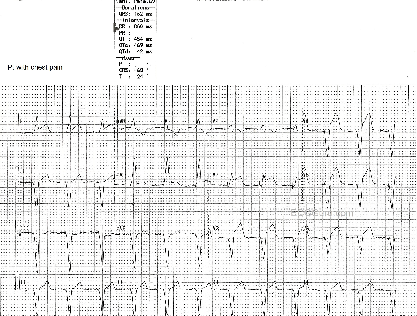 Paced Rhythm With Acute Anterior Lateral M.I. ECG Guru Instructor