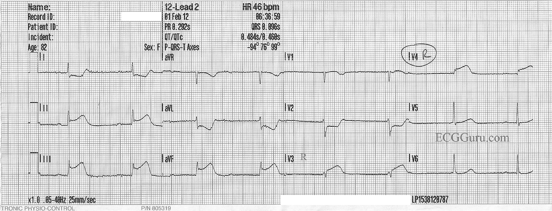 Inferior Wall M.I. With Right Ventricular M.I. ECG Guru Instructor