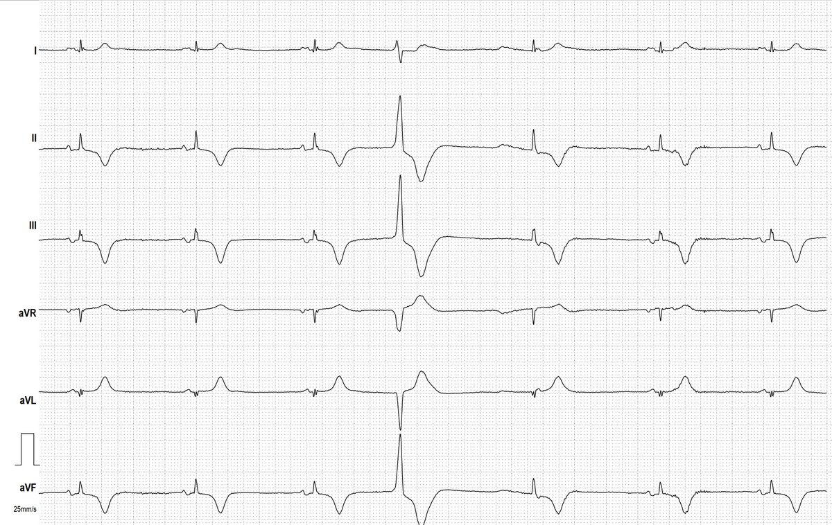 Sinus Bradycardia and More ECG Guru Instructor Resources