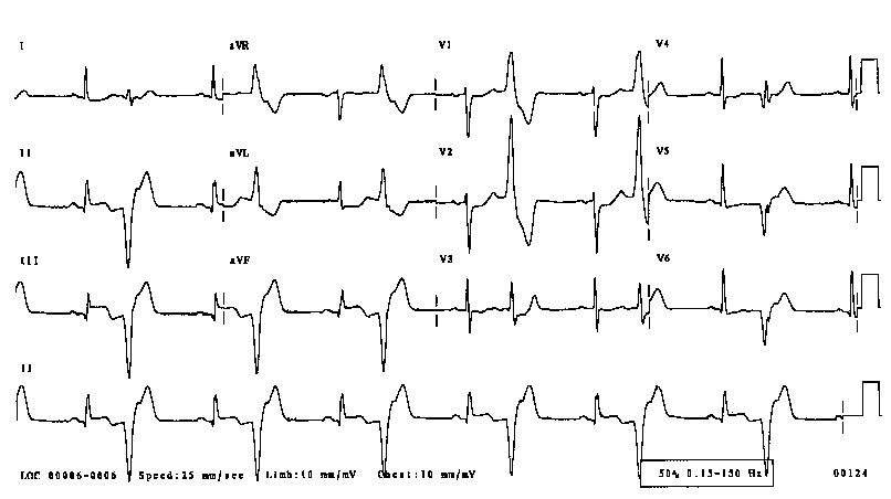 ECG library, Ventricular bigeminy