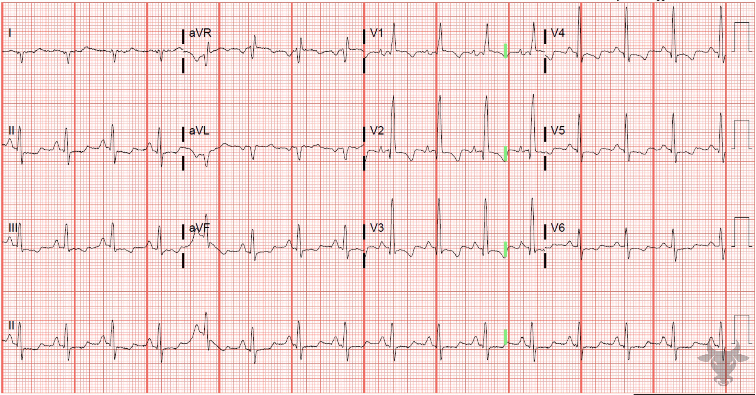 Right Heart Strain ECG Stampede