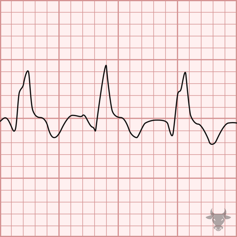 Supraventricular Tachycardia with Aberrancy | ECG Stampede