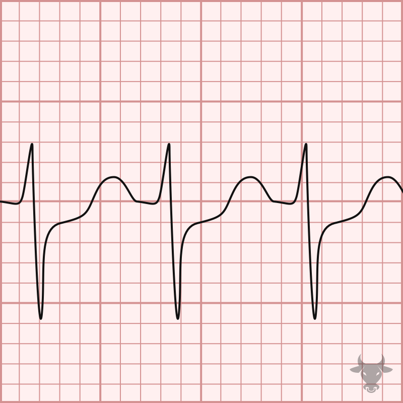 Atrioventricular Reentrant Tachycardia ECG Stampede