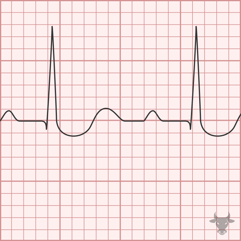 Digitalis Ecg