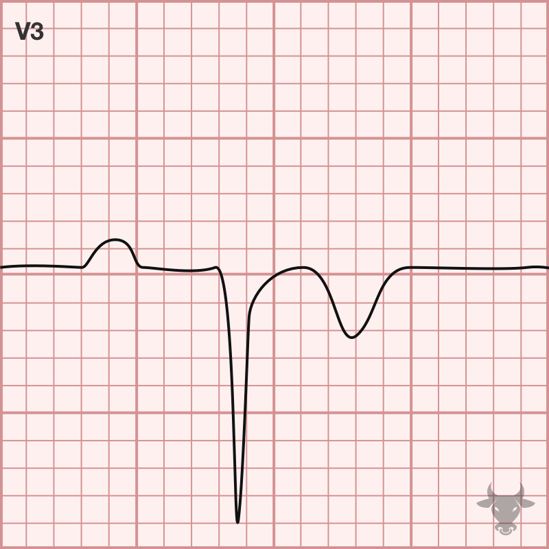 Poor Rwave Progression ECG Stampede