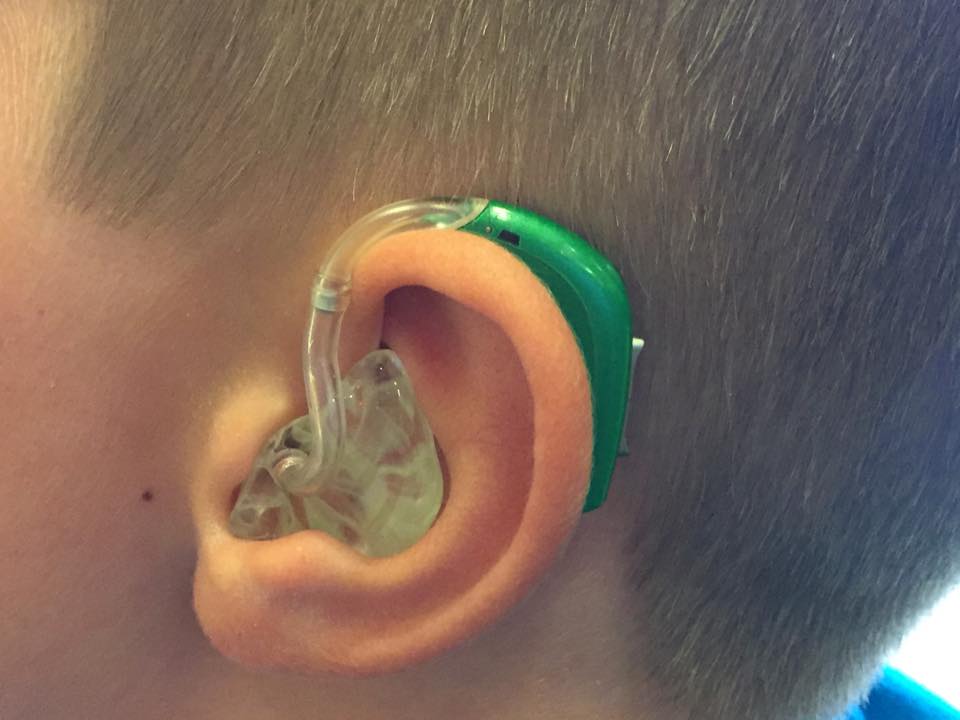 A silent problem Children’s hearing aids are not covered by most