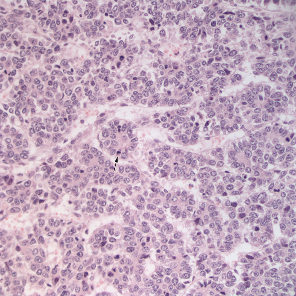Figure 8 Histologic section of a liver mass in a horse eClinpath