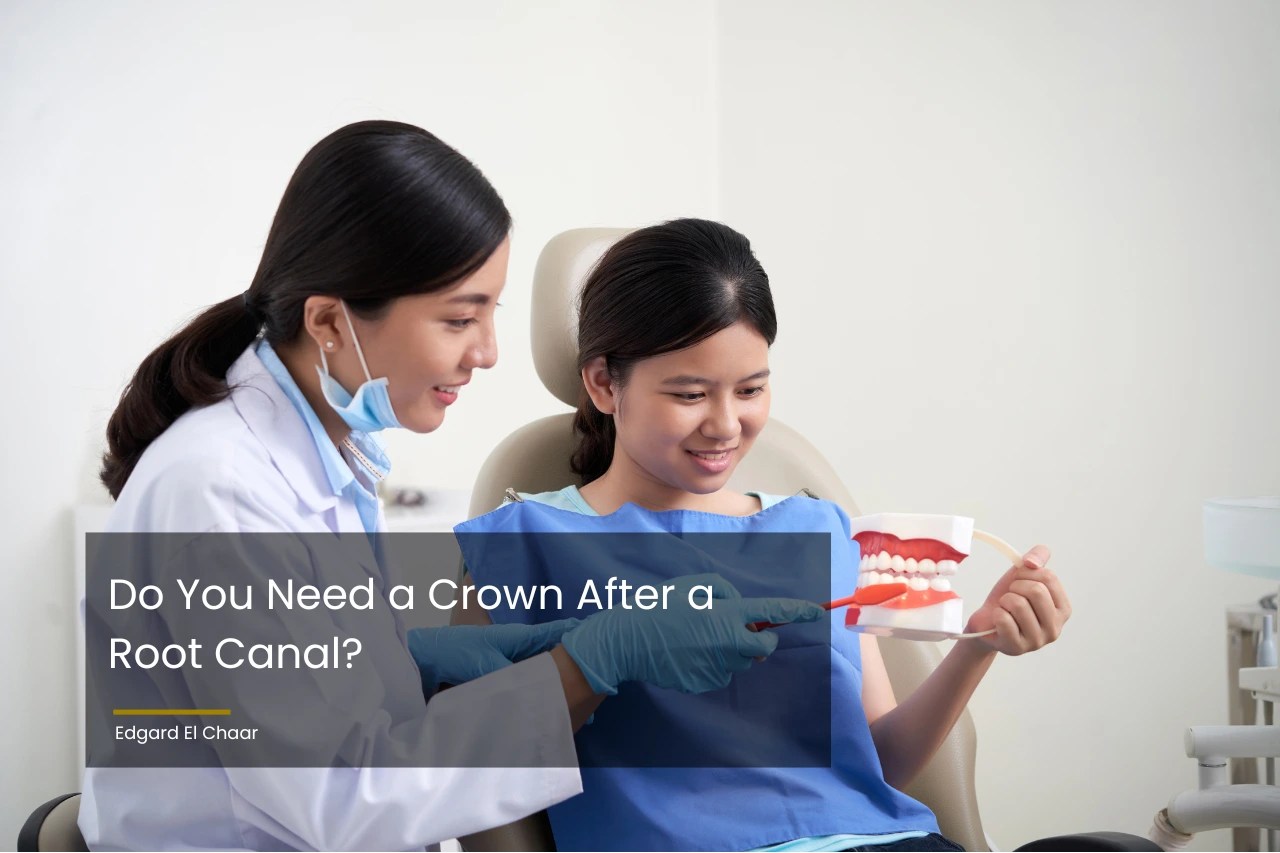 Do You Need a Crown After a Root Canal? Edgard El Chaar
