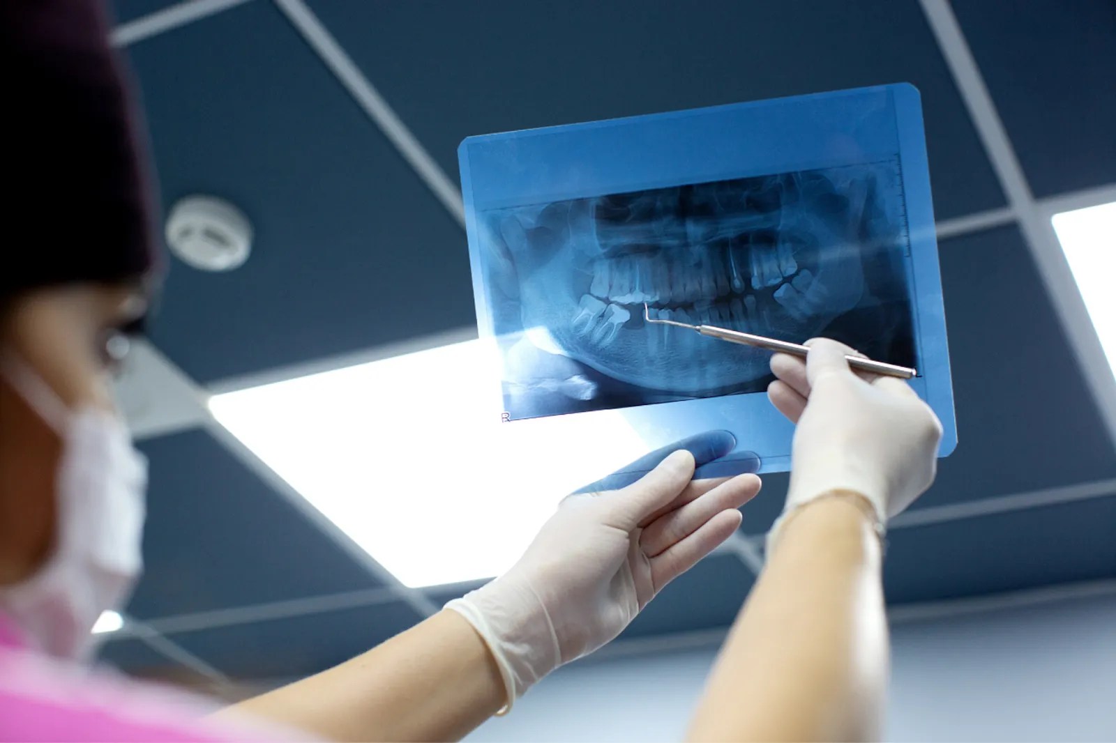 Dry Socket with Bone Graft Causes, Prevention & Treatment