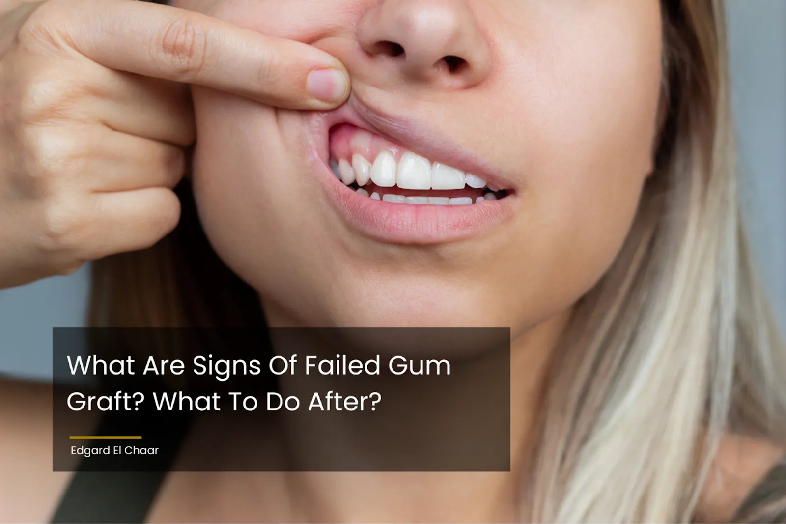 What Are Signs Of Failed Gum Graft? What To Do After?