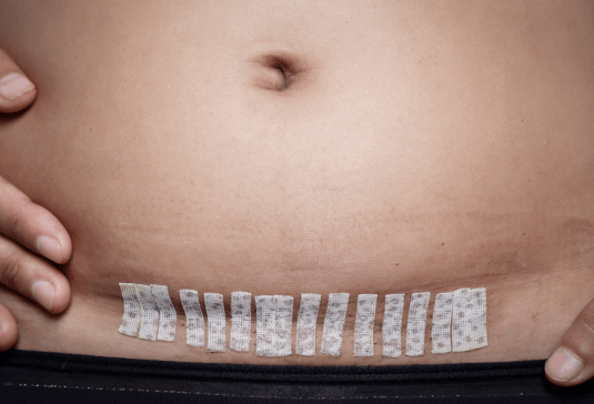 Entenda para que serve a Cirurgia Histerectomia, tipos e efeitos colaterais