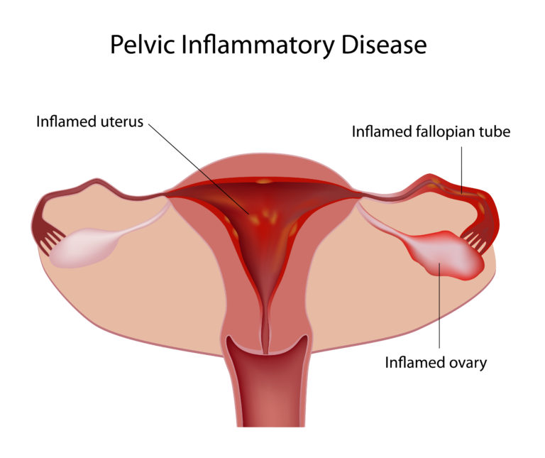 Causes of blocked fallopian tubes and IVF treatment