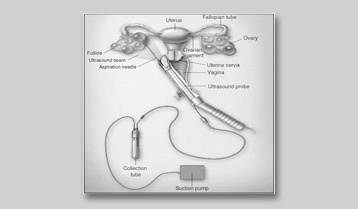Risk of Egg Donation Health, Age, Fertility Risks Explained