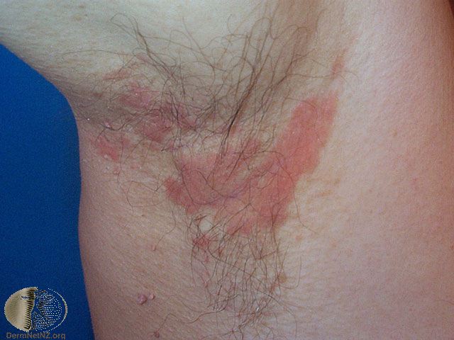 Seborrheic Dermatitis Pictures, Scalp and Face Treatment, Evidence