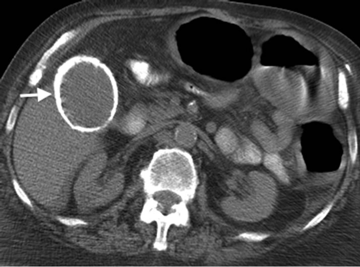 Porcelain Gallbladder, Cancer Risk, Prognosis, Images