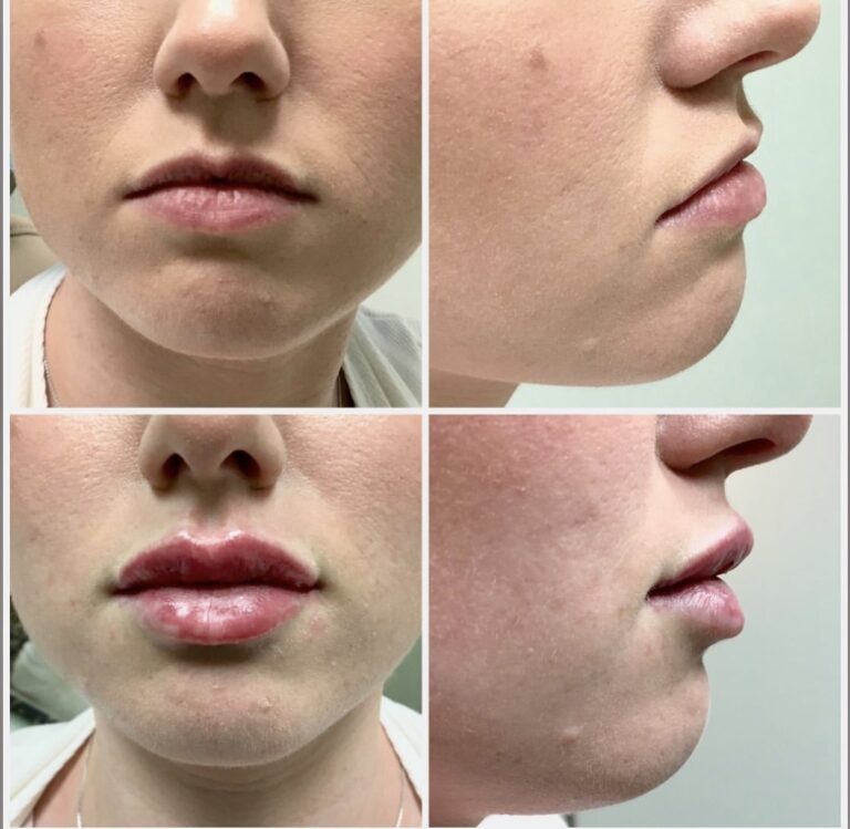 Revanesse Versa Lip Injections Fayetteville, NC Élan Med Spa