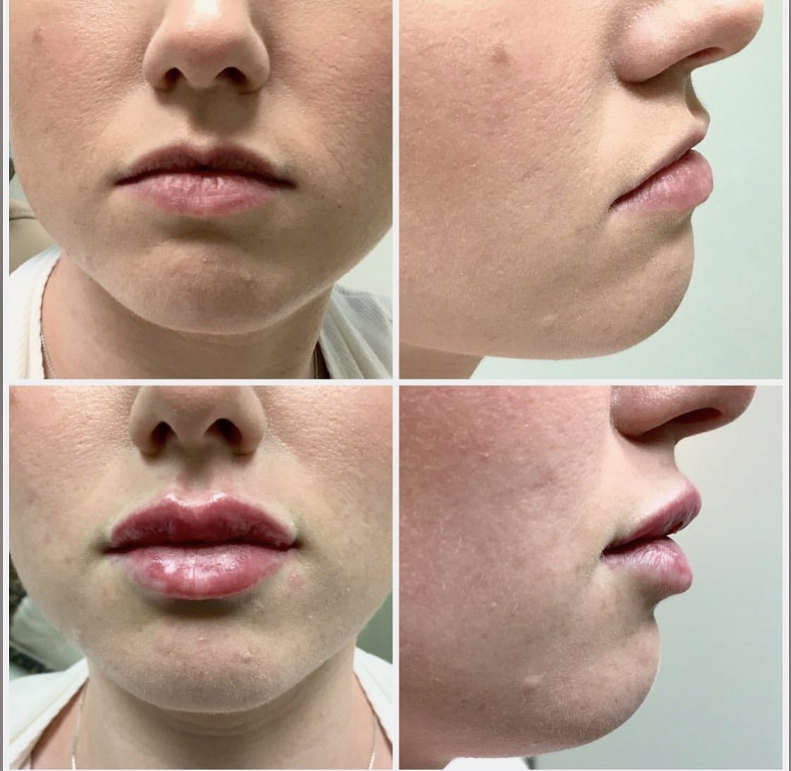 Revanesse Versa Lip Injections Fayetteville, NC Élan Med Spa