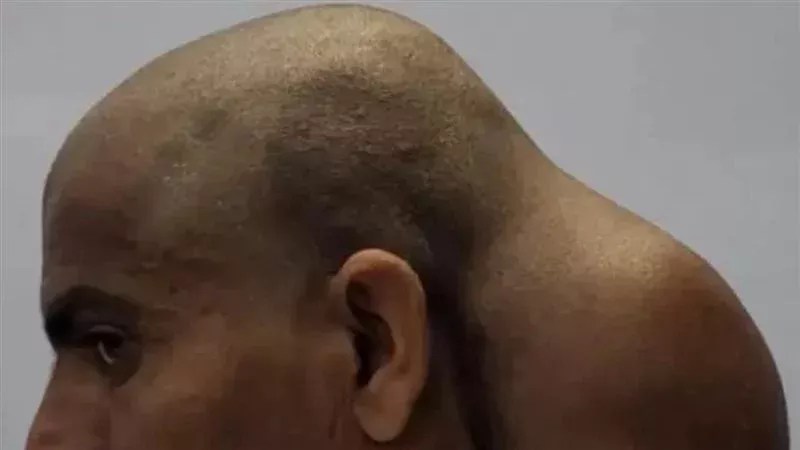 اصابه الاكتئاب..شاب هندي يعيش بورم كبير في الرأس اصابه الاكتئاب..شاب هندي يعيش بورم كبير في الرأس