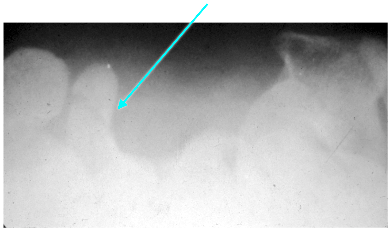 Golf Injury of the Hand and WristGolfer ElbowMedial
