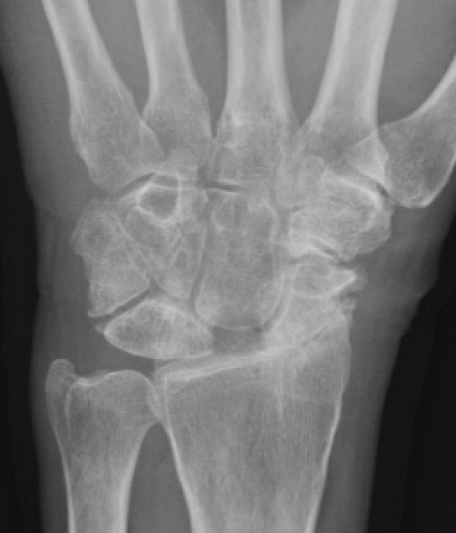 Arthritis PostTraumatic ArthritisHand SurgeryWrist SurgeryElbow Surgery