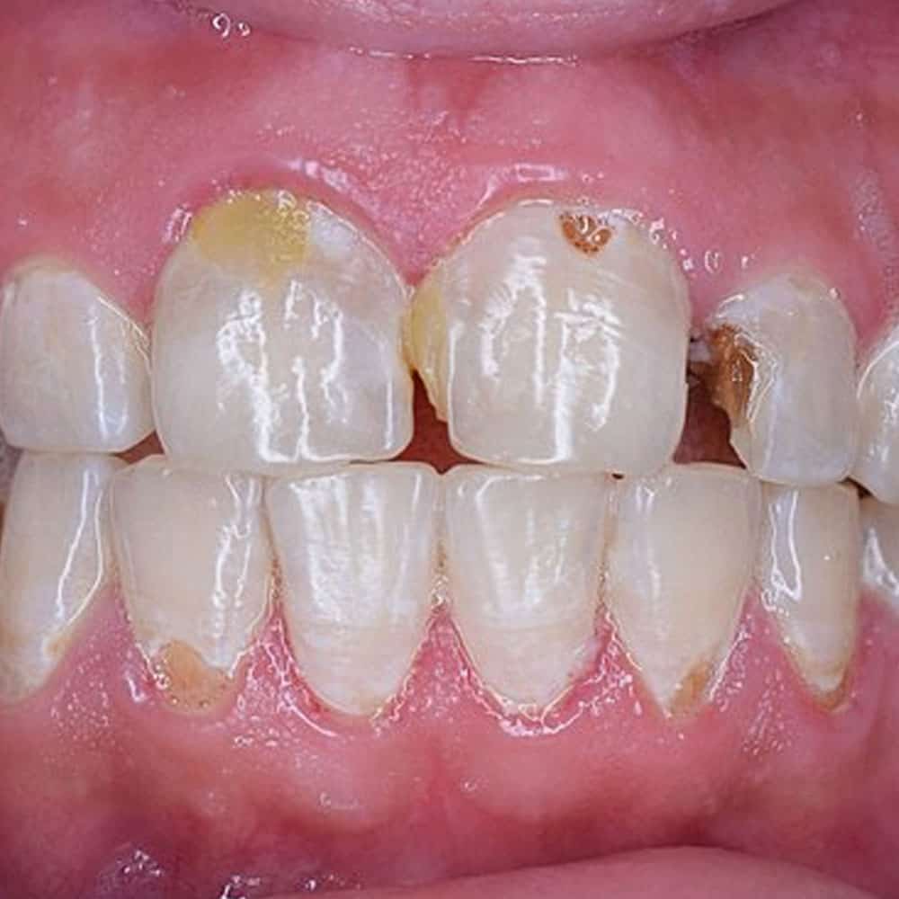 Tooth Decay Signs, Symptoms & Treatments Electric Teeth UK