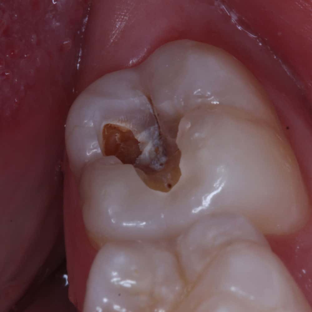 Tooth Decay Signs, Symptoms & Treatments Electric Teeth UK