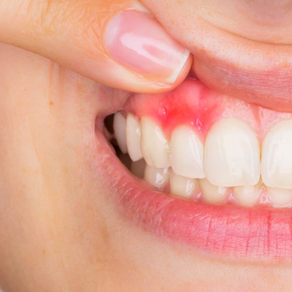 how to treat small gum abscess at home Annabel Beckwith