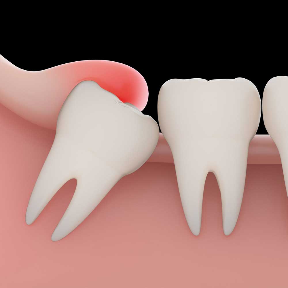 Wisdom Tooth Pain Symptoms, Removal Procedure & FAQ Electric Teeth