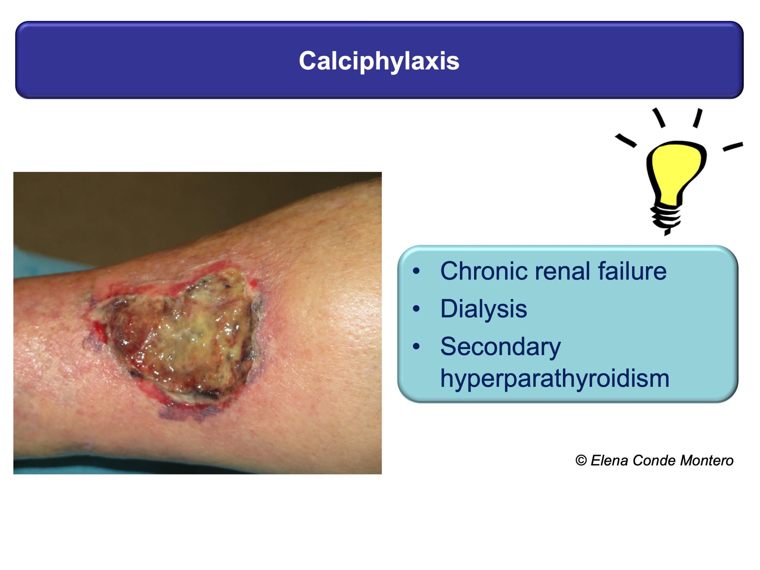 Leg Ulcer Wound Care