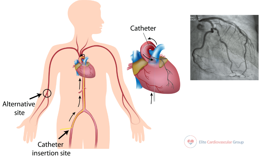 Cardiac Catheterization Elite Cardiovascular Group