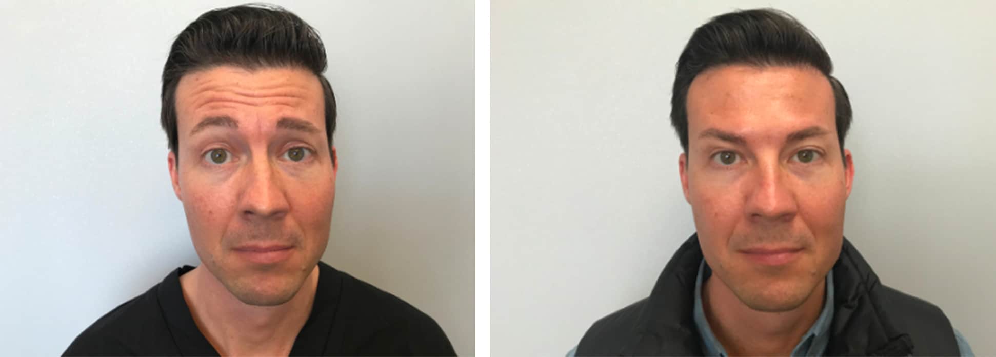 NonSurgical Treatments in Grand Rapids MI Botox Grand Rapids