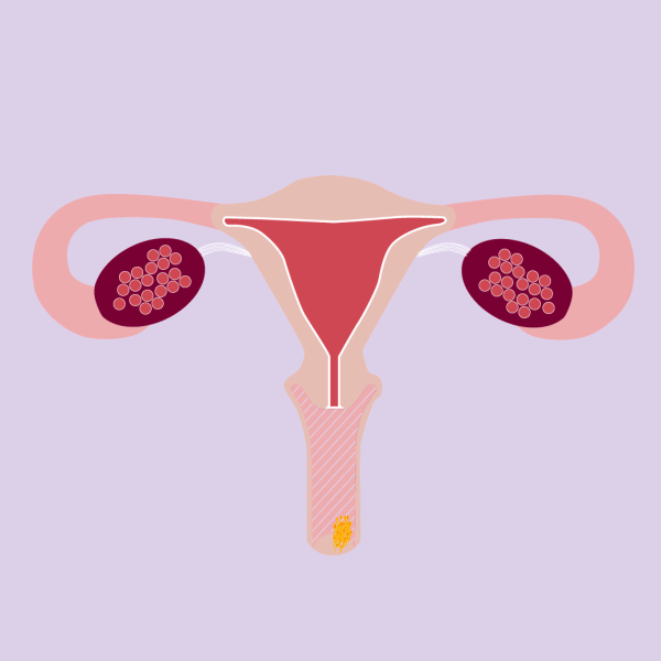 Can you take ellaOne® twice in one cycle? ellaone IE