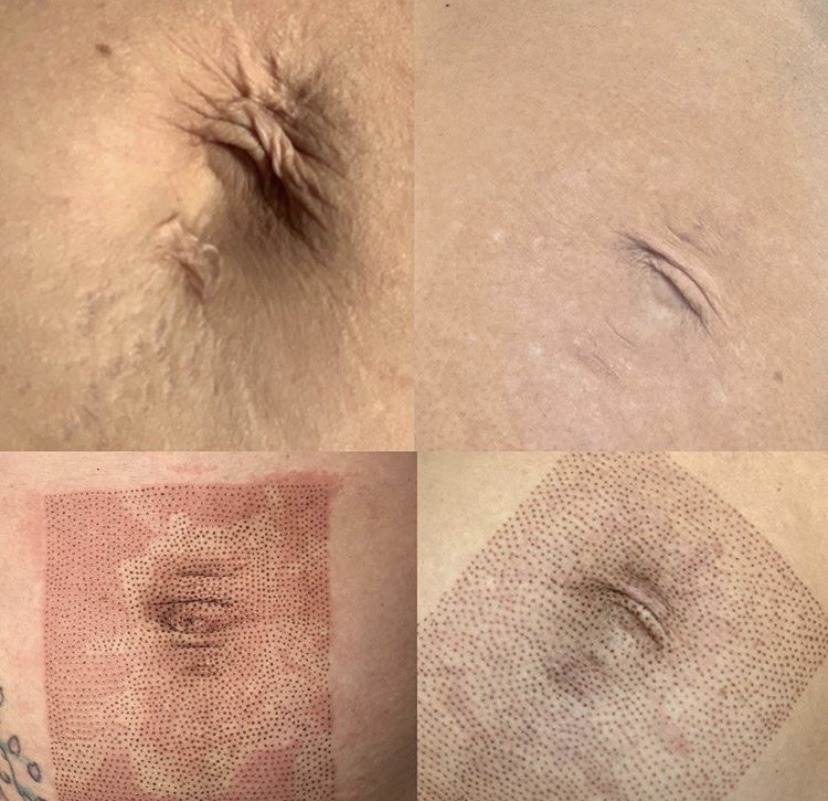 Elmira Studio Plasma Pen Treatments Westlake Village, CA