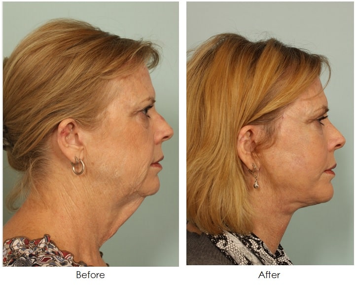 How Much Does a Facelift Cost? Facelift El Paso TX El Paso Cosmetic