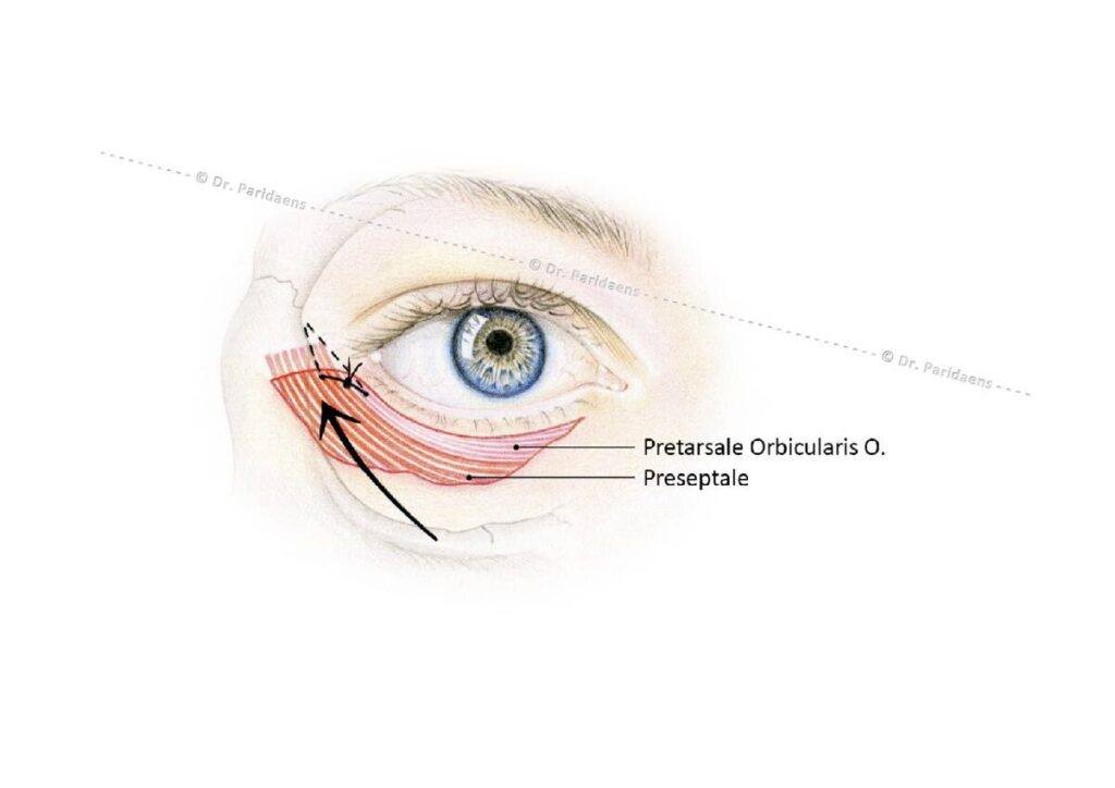 Puffiness under the eyes and the risks of surgery