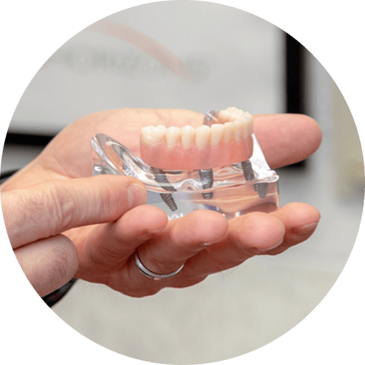 Allon4 Full Mouth Dental Implants Florence Louisville, KY
