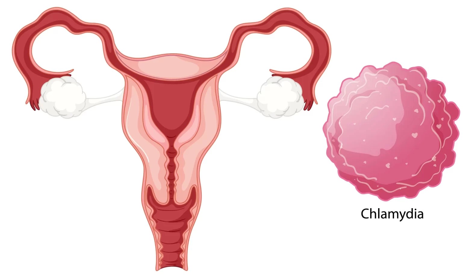 Can you get Pregnant with Chlamydia? Ram Prakash Embryologist
