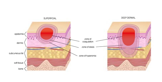 Minor burn treatment Emergency Medicine Kenya Foundation