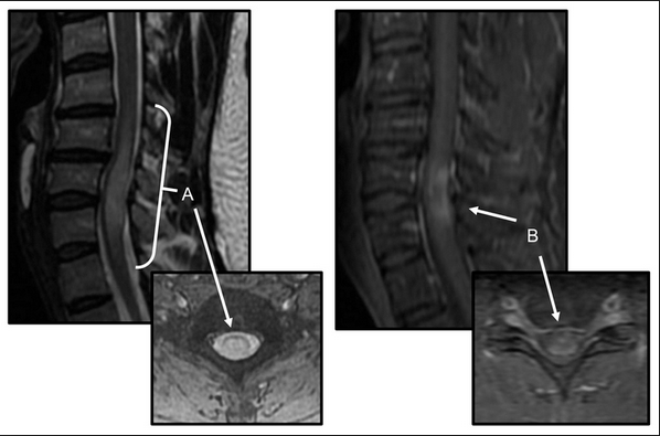 They most commonly affect elderly men and are classically found in the thoracolumbar region. Emdocs Net Emergency Medicine Educationtraversing Transverse Myelitis Emdocs Net Emergency Medicine Education