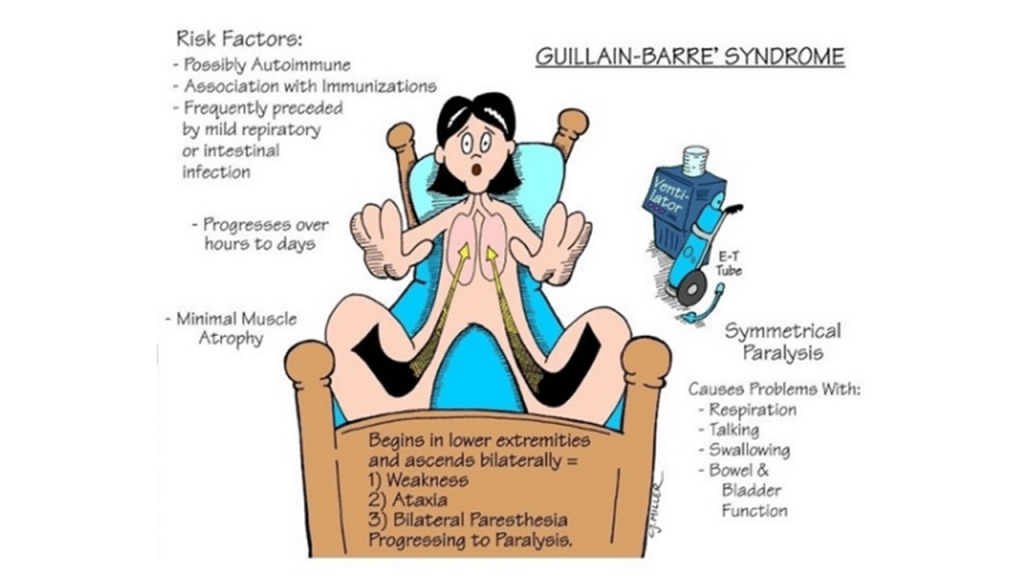 Emergency Medicine EducationGuillainBarré Syndrome