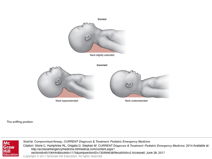 Emergency Medicine EducationSniffing position