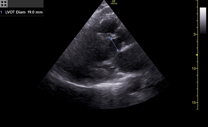 Emergency Medicine EducationPOCUS for Aortic Stenosis