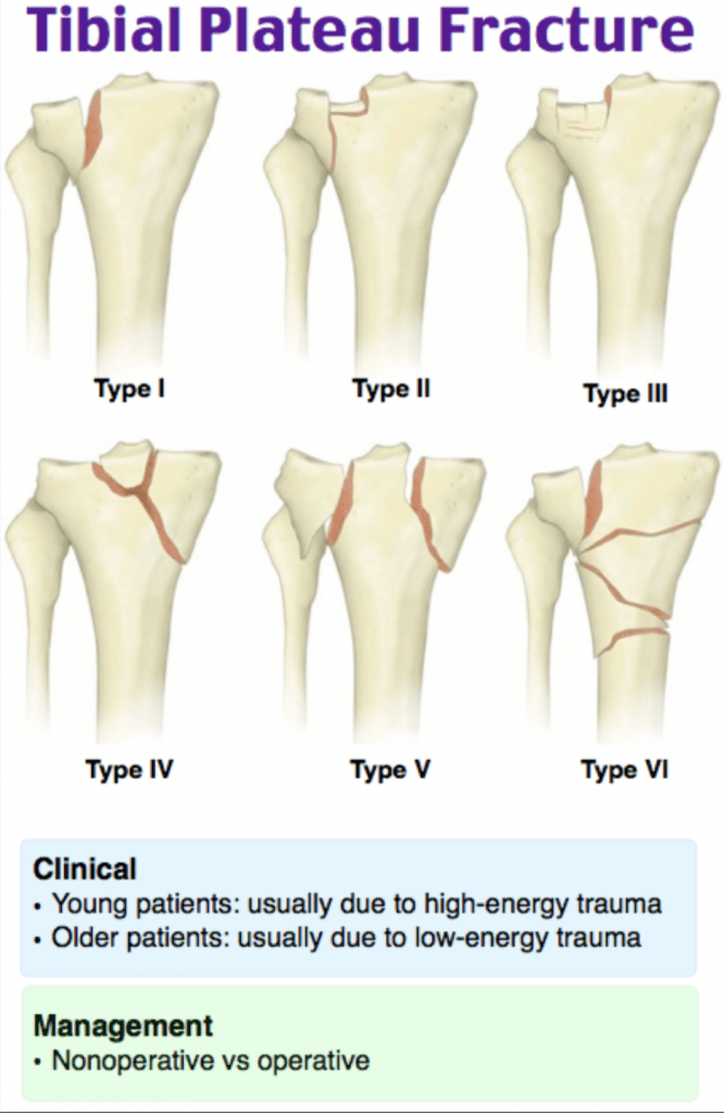 Emergency Medicine EducationEM3AM Tibial Plateau