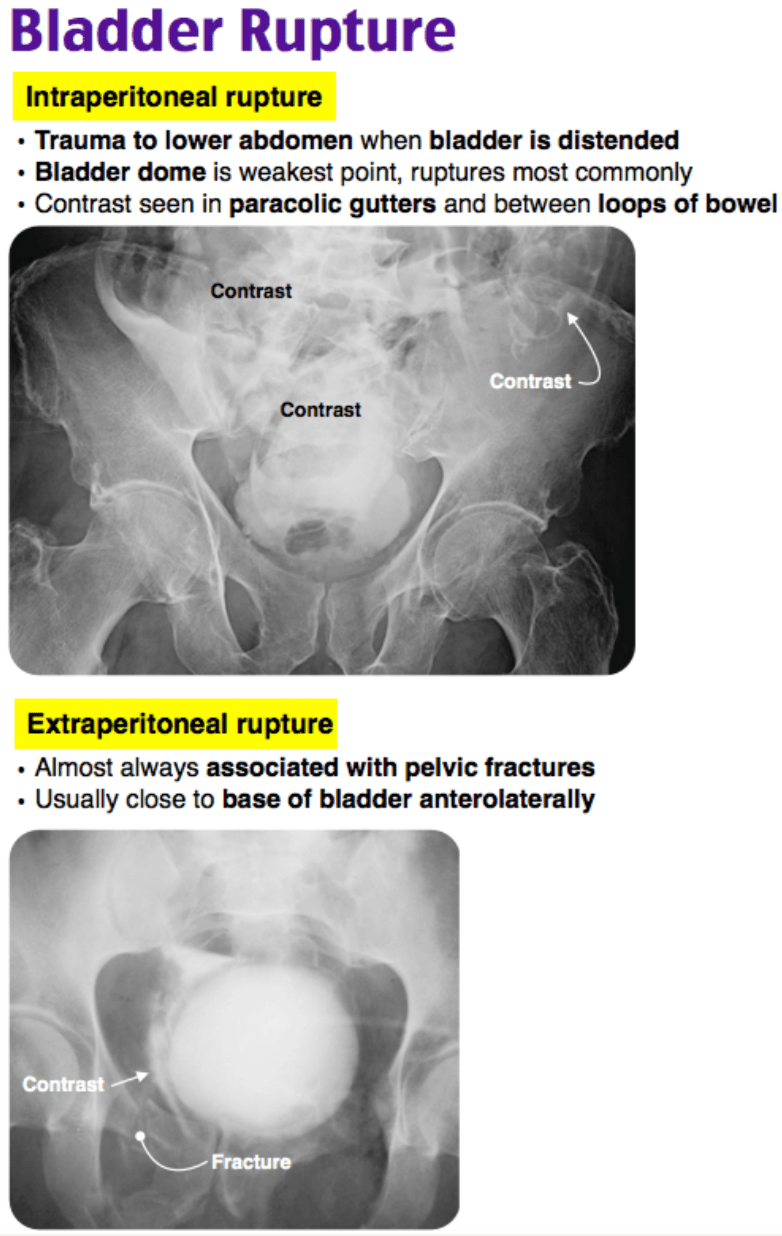 Emergency Medicine EducationEM3AM Bladder Rupture
