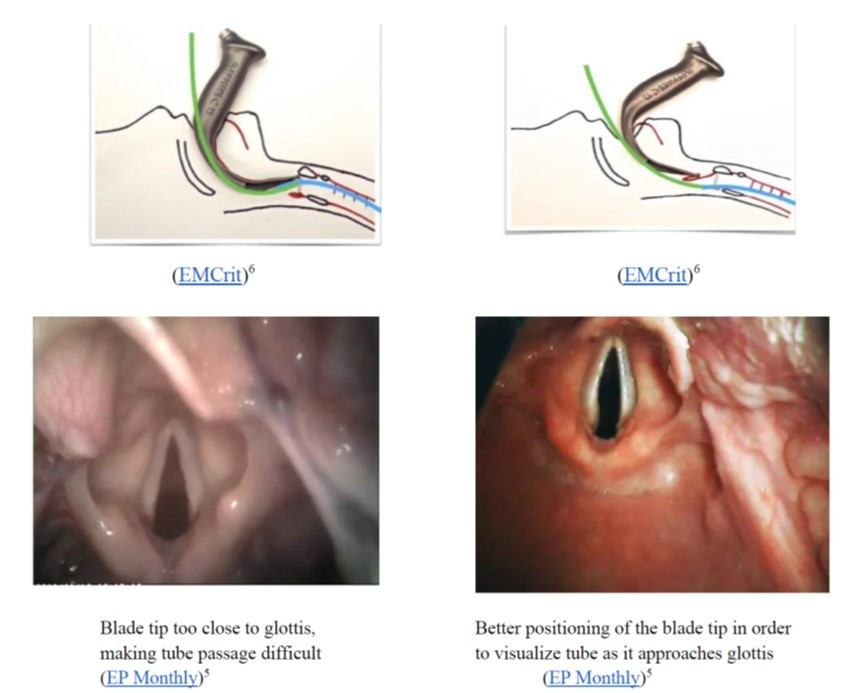 Emergency Medicine EducationVideo Laryngoscopy in the ED